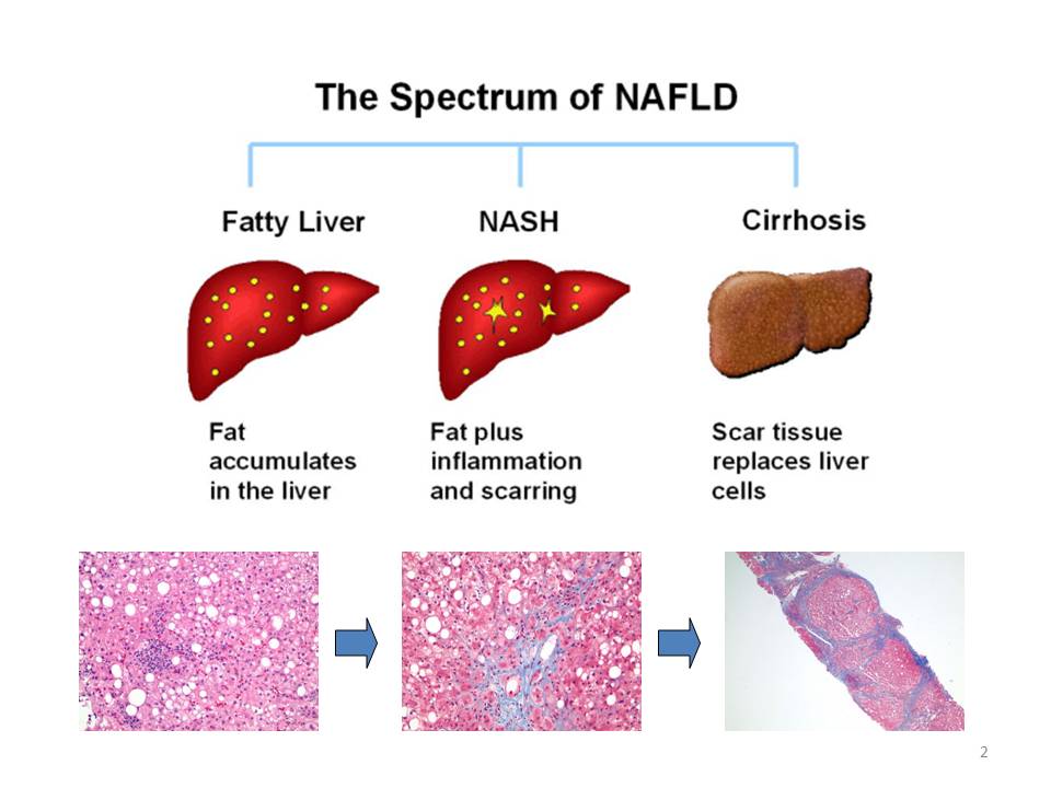 the spectrum of NAFLD