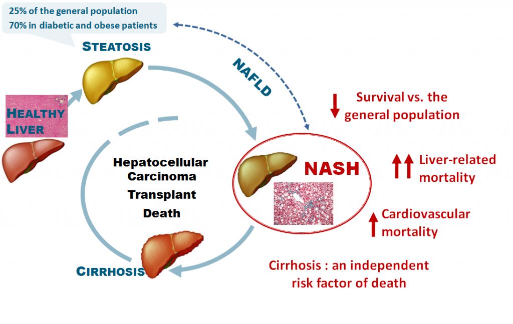 cirrhosis